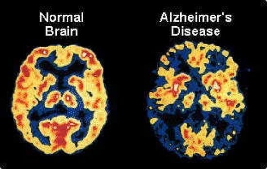 Comparison image of two brain scans: the left shows a "Normal Brain" with even coloring, while the right displays an "Alzheimer's Disease" brain with noticeable dark areas indicating affected regions. Understanding these changes can be a step toward Alzheimer's prevention.